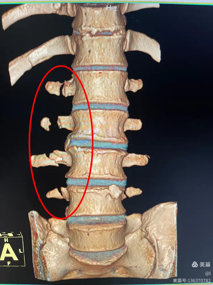 冕宁漫水湾友松医院放射科～外伤ct三维重建篇